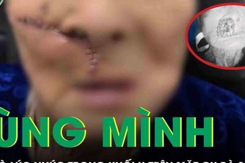 Rùng mình: Giòi bò lúc nhúc trong khối u trên mặt cụ bà 88 tuổi ở Quảng Nam