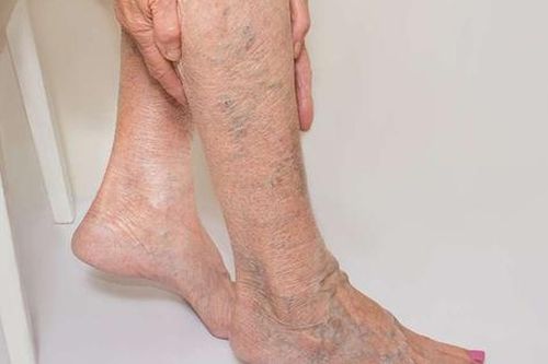 Các yếu tố nguy cơ gây suy tĩnh mạch chi dưới