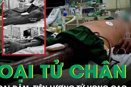 Lội xuống đầm tôm, người đàn ông hoại tử chân vì bị gai đâm, tiên lượng tử vong cao