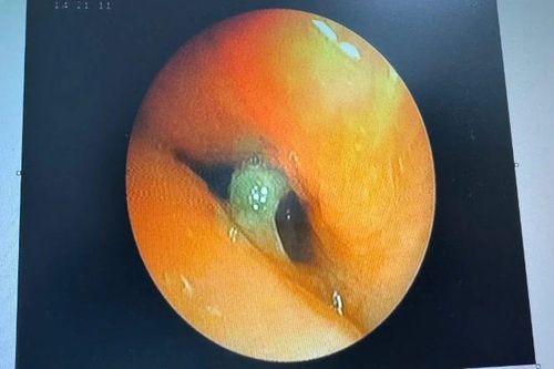Mổ nội soi lấy mảnh xương sắc cạnh ra khỏi phế quản bệnh nhân lớn tuổi