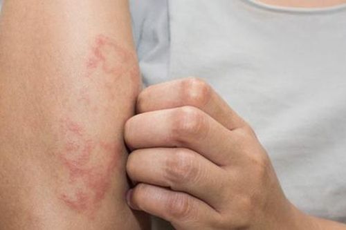 Cách giúp giảm tình trạng mụn nước, ngứa ngáy khó chịu mùa hè
