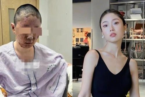 Người mẫu Đồng Dao biến dạng khuôn mặt sau vụ nổ kinh hoàng