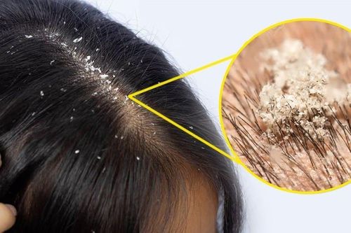 Dầu gội trị gàu ngứa da đầu: Chọn đúng, dùng đúng mới hiệu quả