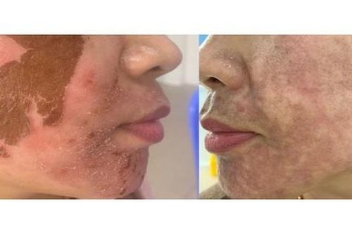 Trị nám 'cấp tốc': Trào lưu nguy hiểm từ các cơ sở thẩm mỹ 'chui'
