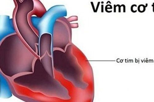 Viêm cơ tim có gây biến chứng không?