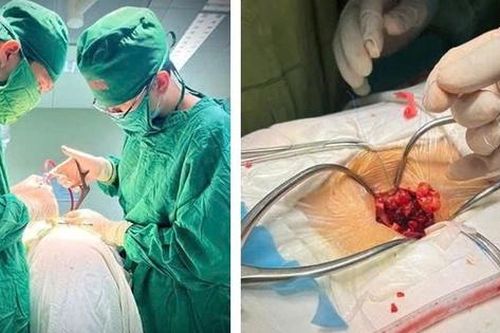 Bệnh viện Hữu nghị Đa khoa Nghệ An phẫu thuật thành công u tủy hình quả tạ