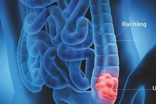 5 bí quyết giảm nguy cơ mắc ung thư đại tràng