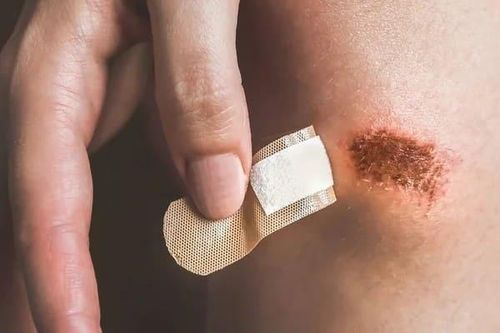 Vì sao vết thương của bạn lâu lành?