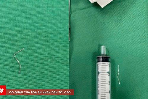 Gắp thành công dị vật kim loại dài 3cm trong lưỡi bé 12 tháng tuổi