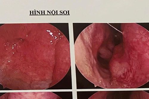 Gia Lai: Một thanh niên có răng mọc ở… hốc mũi