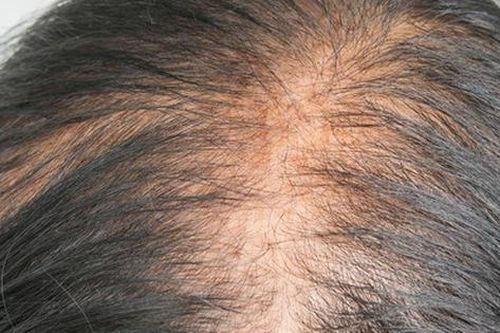 Phương pháp tốt nhất điều trị rụng tóc cho phụ nữ