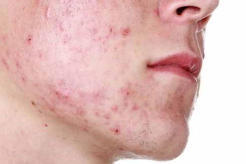 Cách trị mụn trứng cá hiệu quả nhất