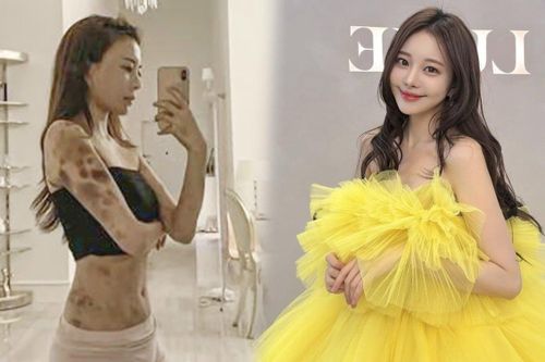 Hot girl Hàn bàng hoàng khi cả cơ thể bầm tím sau 2 giờ gây mê làm đẹp