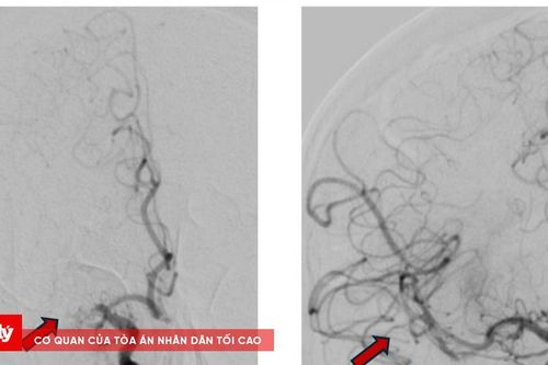 Bệnh viện TP.HCM cứu sống một người Nga đột quỵ nặng
