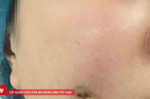 Bị nhiễm trùng sau khi phẫu thuật tạo má lúm đồng tiền