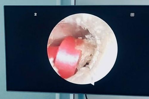 Bé gái 6 tuổi đi viện do sợi dây chun buộc tóc