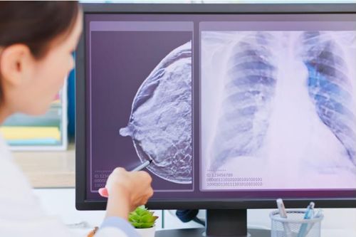 AstraZeneca công bố thuốc đột phá trong điều trị ung thư vú