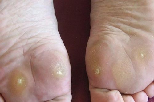 Vì sao chai chân lại gây đau nhức và cách xử lý, phòng ngừa hiệu quả