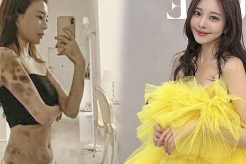 Nữ người mẫu thắng kiện phòng khám sau 4 năm bị hủy hoại sức khỏe, phơi bày mặt tối ngành thẩm mỹ