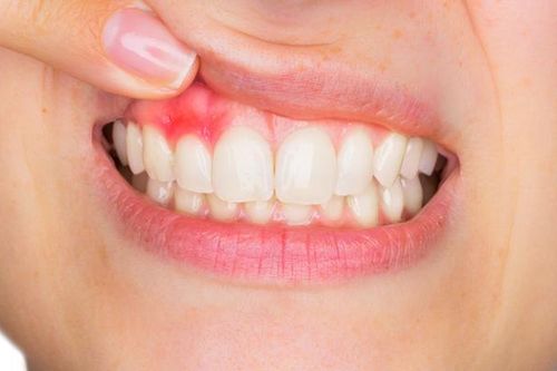 Răng miệng 'kêu cứu', cơ thể 'rung chuông': Mối liên hệ nguy hiểm cần biết
