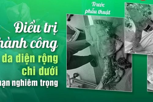Điều trị thành công ca lóc da diện rộng