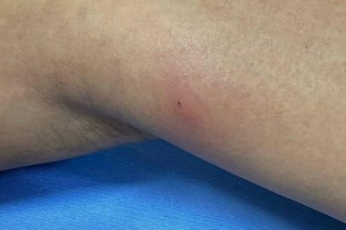 Sán dài khoảng 20 cm chui ra từ chân do thói quen ăn đồ sống