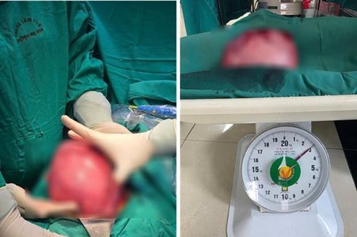 TTYT Hạ Hòa phẫu thuật thành công khối u xơ tử cung kích thước lớn hiếm gặp
