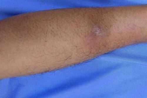 Sán 20 cm 'đục lỗ' trên cơ thể người đàn ông có thói quen ăn đồ sống