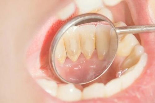 Cách nhận biết cao răng đang tích tụ