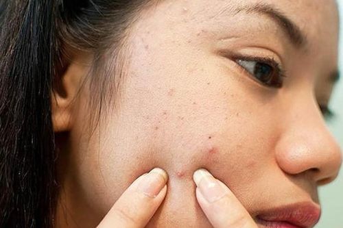 Sau nặn mụn không nên ăn gì?