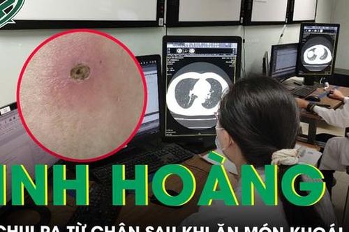 Kinh hoàng: Sán chui ra từ chân hai anh em sau bữa ăn món khoái khẩu
