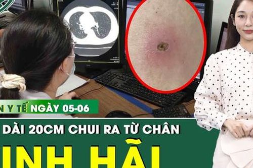 Bản tin Y tế 5/6: Kinh hãi giun sán chui ra từ chân 2 anh em do ăn món khoái khẩu