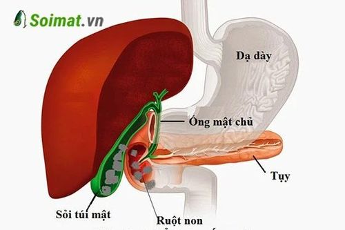 Chủ quan với sỏi túi mật, người phụ nữ bị tắc ruột