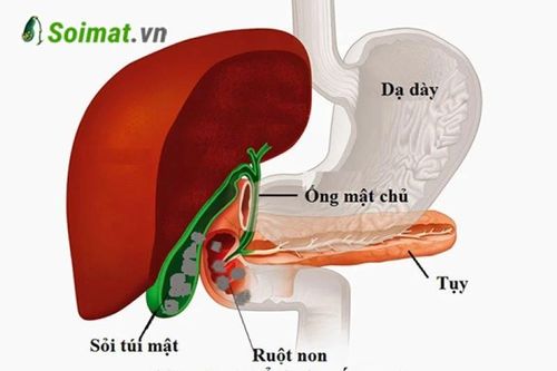 Tắc ruột do sỏi túi mật, 'quả bom nổ chậm' ít ai ngờ