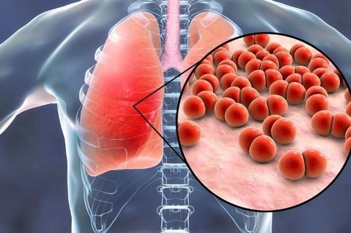 Phế cầu khuẩn đang tạo gánh nặng lớn cho ngành y tế lẫn chi phí điều trị