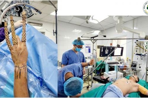 Bệnh viện 19-8 phẫu thuật nội soi nối rách đĩa sụn sợi tam giác cổ tay với trợ cụ đặc biệt tự tạo