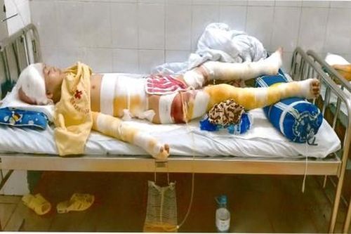 Cậu bé đi làm thuê bị bỏng nặng mong được giúp đỡ