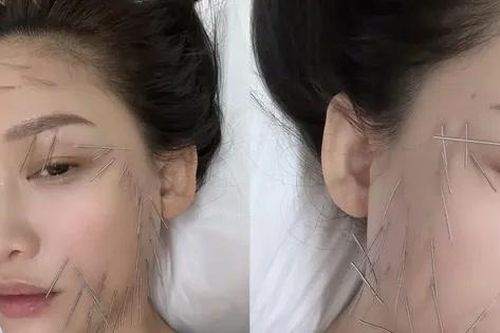 Trần Kiều Ân gây tranh cãi với phương pháp làm đẹp đau đớn