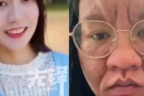 Mẹ bỉm gây bão mạng vì mặt mũi 'biến dạng' khi mang thai