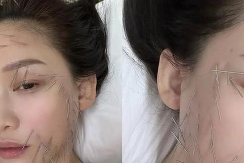 'Nữ hoàng phim thần tượng' gây sốt khi cắm hàng trăm chiếc kim khắp cơ thể