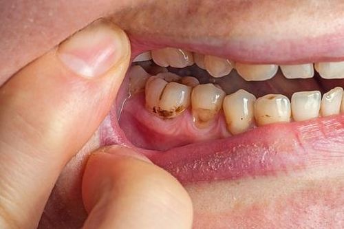 Có nên lấy cao răng tại nhà?