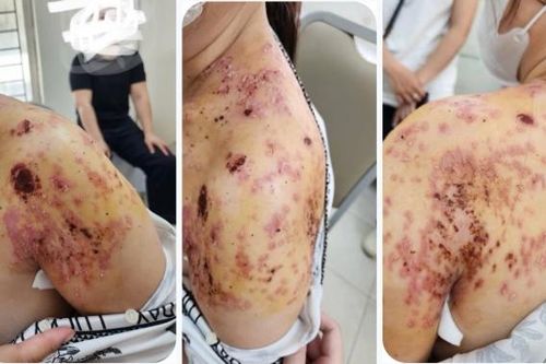 Bó lá điều trị gãy xương đòn, người phụ nữ ở Hà Nội bị bỏng da và nhiễm trùng nặng