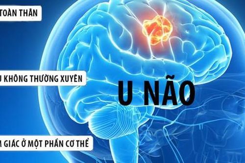 Đau đầu cảnh giác với u màng não