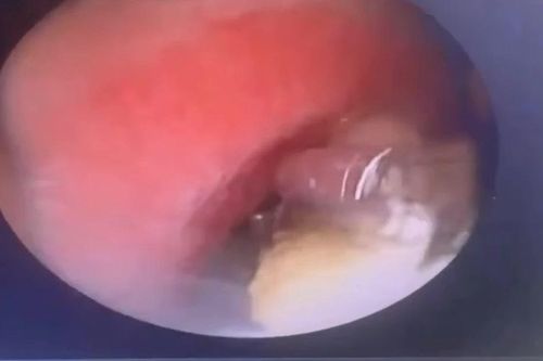 Ho khó thở, cụ ông 81 tuổi phát hiện răng mắc ở phế quản gốc