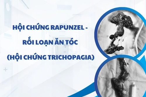 Lấy khối tóc lớn trong dạ dày bé 7 tuổi thích ăn tóc