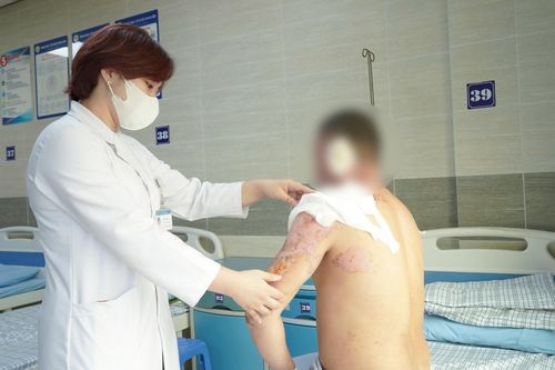 Người đàn ông bị bỏng nặng do xăng bén lửa
