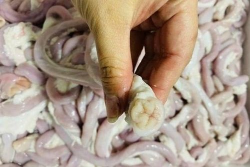 Người phụ nữ bán lòng lợn nhiễm liên cầu khuẩn