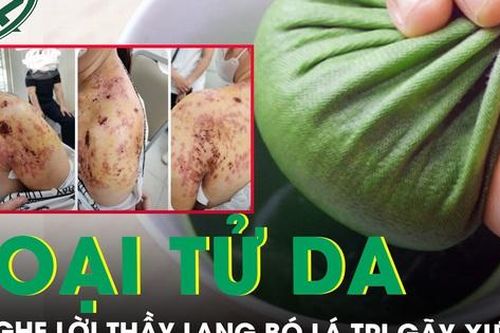 Hoại tử da vì nghe lời thầy lang bó lá trị gãy xương
