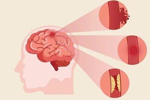 Phục hồi chức năng sau tai biến mạch máu não