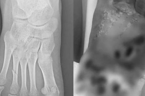 Bé gái 14 tuổi hoại tử chân vì sai lầm phổ biến của nhiều gia đình